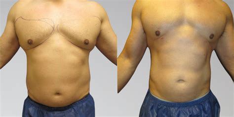 Liposuction for Men Miami 